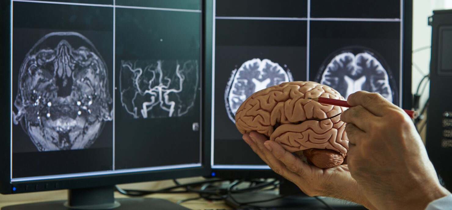 A medical professional holds a detailed anatomical model of a human brain while pointing at a specific region with a red pencil. In the background, two computer monitors display MRI brain scans with various cross-sectional images of the brain’s structure and blood vessels. The setting suggests a neurology or radiology environment.