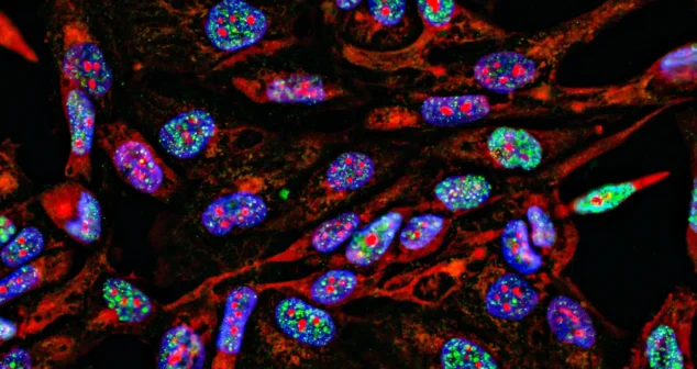 Fluorescent Imaging immunofluorescence of cancer cells growing in 2D with nuclei in blue, cytoplasm in red and DNA damage foci in green