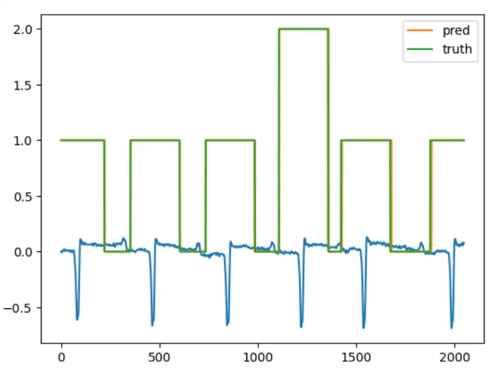 AI ECG arrhythmia detection model prediction compared to ground truth segmentation on real-world waveform data
