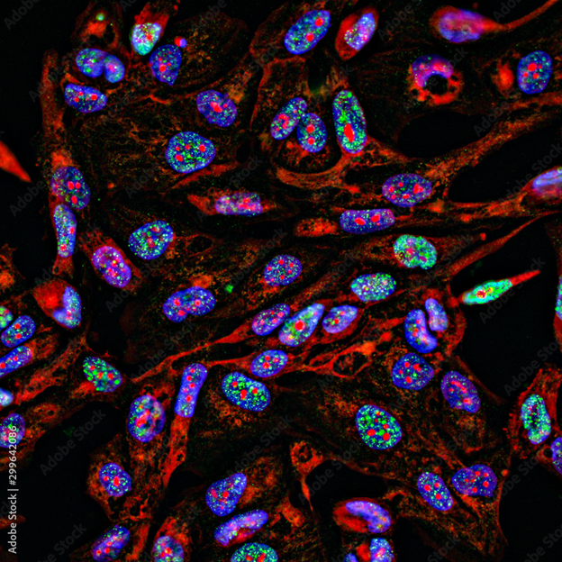 Fluorescence Imaging in Medical Devices Cancer Cells imaged by fluorescence microscope