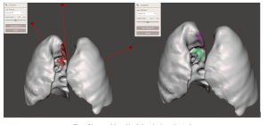  Lung model repairing holes using inspection tool