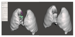  Lung model local smoothing using RobustSmooth brush