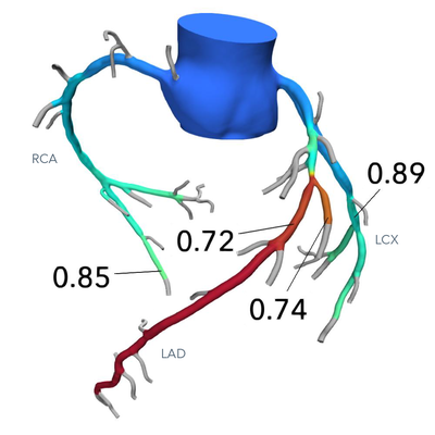 A 3D anatomical rendering of coronary arteries branching from the heart. The vessels are color-coded based on fractional flow reserve (FFR) values labeled along the arteries: LAD (0.72, 0.74), RCA (0.85), and LCX (0.89). The colors range from red (lower FFR) to green (higher FFR), indicating areas of potential ischemia.