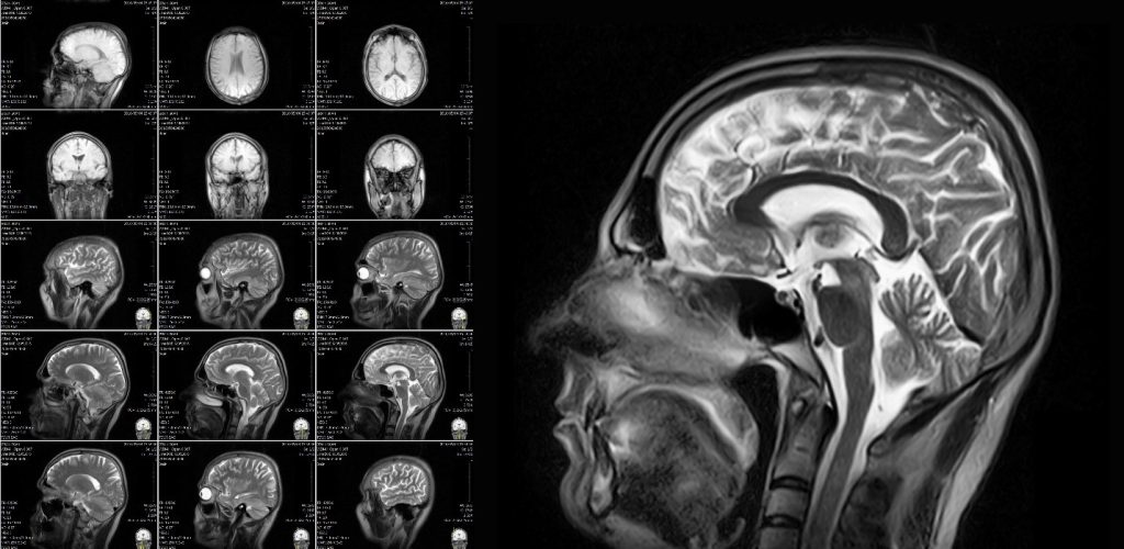 Examples of different cross-section views of a human brain from an MRI that can guide treatments