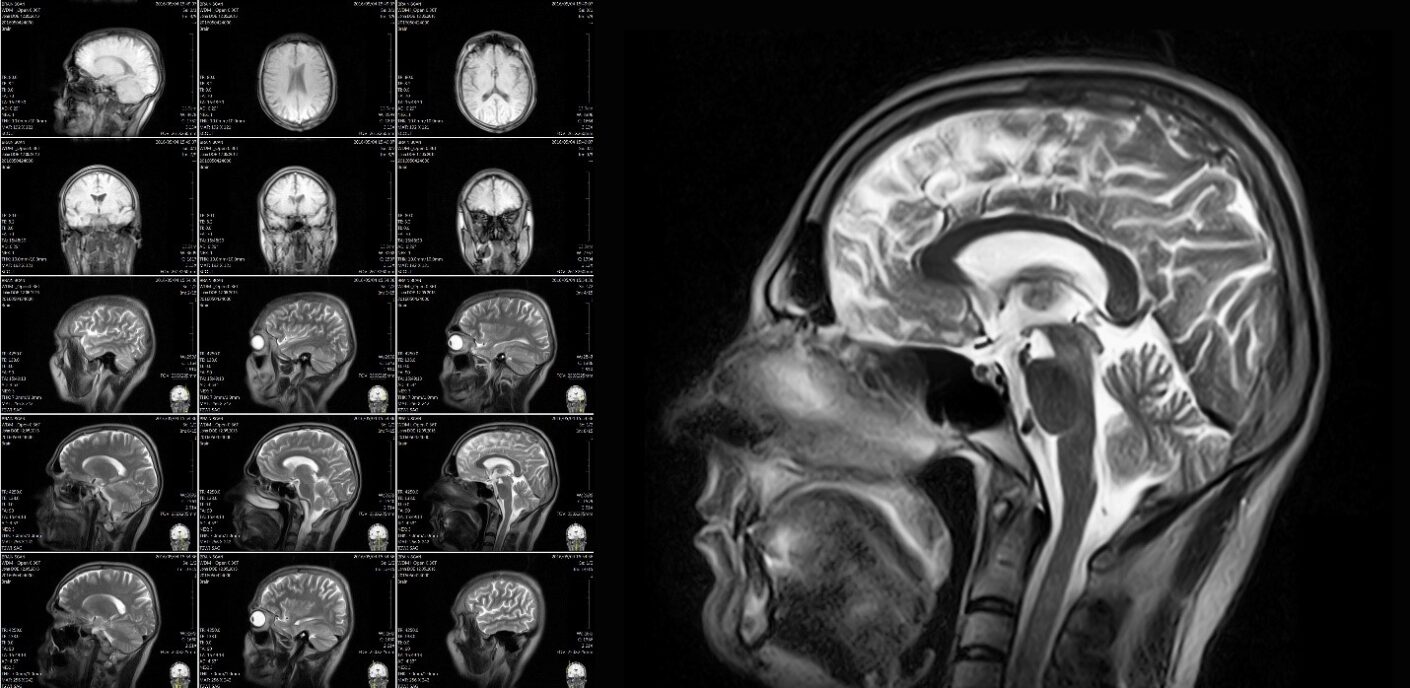 MRI image that can be used to direct treatments to specific parts of the brain