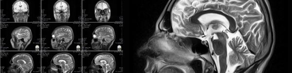 Drug Delivery System Imaging - MRI image that can be used to direct treatments to specific parts of the brain