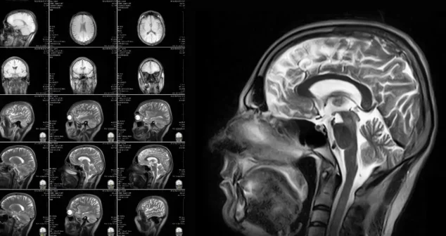 Examples of different cross-section views of a human brain from an MRI that can guide treatments