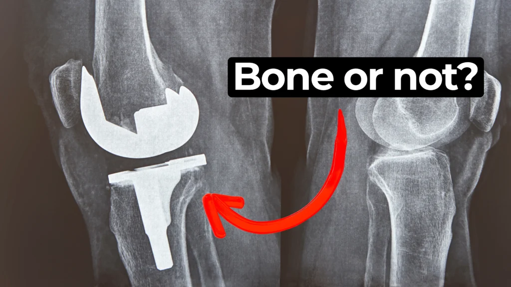 X-ray image showing two human knees side-by-side. The right knee appears intact with natural bone structure, while the left knee has a visible knee replacement implant, including metallic components. A bold caption in the upper center reads "Bone or not?" and a red curved arrow points from the text to the knee with the implant, emphasizing the contrast between natural bone and artificial joint.