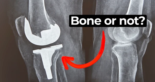 X-ray image showing two human knees side-by-side. The right knee appears intact with natural bone structure, while the left knee has a visible knee replacement implant, including metallic components. A bold caption in the upper center reads "Bone or not?" and a red curved arrow points from the text to the knee with the implant, emphasizing the contrast between natural bone and artificial joint.