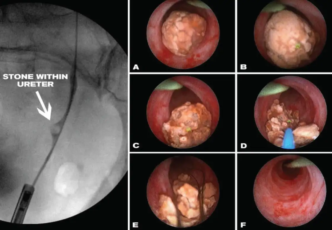 Laser lithotripsy procedure showing endoscopic views of kidney stone fragmentation and removal using Ho:YAG laser