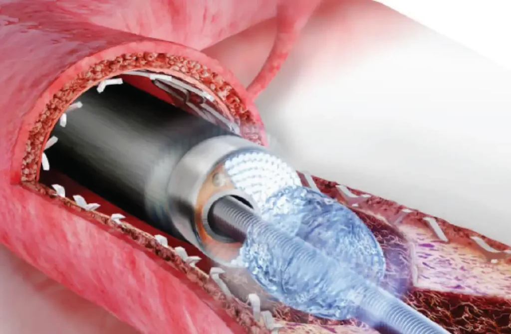 Medical illustration of laser angioplasty catheter clearing a blocked coronary artery through laser vaporization